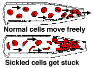 Sickle Cell diagram